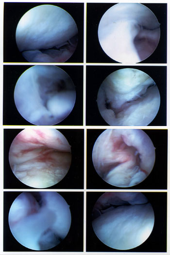 Arthsoskopiefotos 9. Mai 2008; Klicken für grosse Fassung