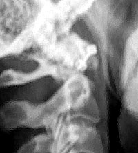 Interessantes Objekt auf der Halswirbelsäule... oder....? (August 2007)